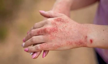 “Qara qızılca” ölümlə nəticələnə bilər - Həkimdən xəbərdarlıq