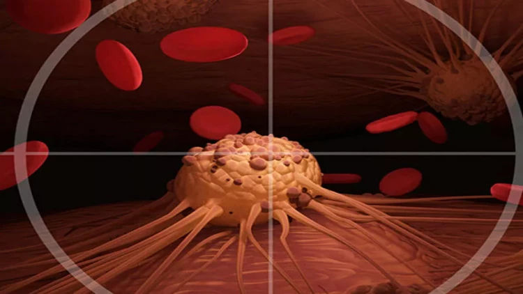 Xərçəngin çarəsi tapıldı