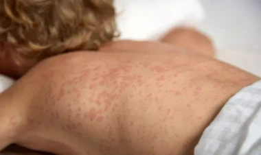 Qızılca xəstəliyinə görə məktəblilər distant təhsilə KEÇDİ