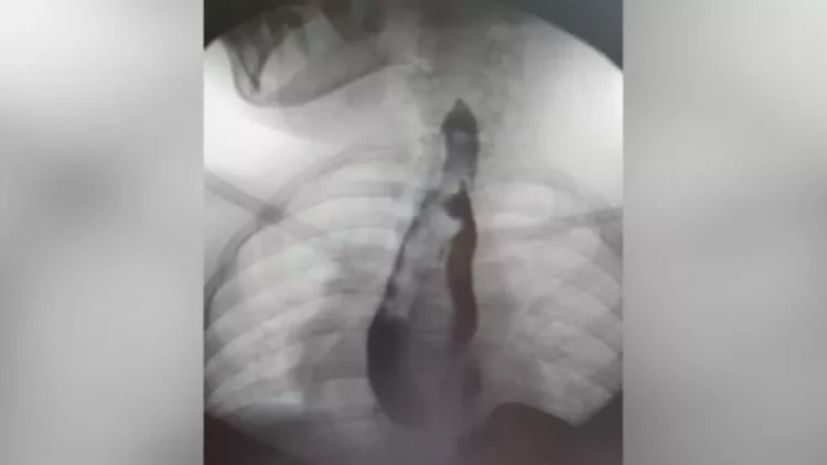 İki mədəsi olan qız əməliyyat olundu