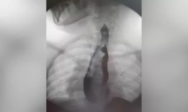 İki mədəsi olan qız əməliyyat olundu