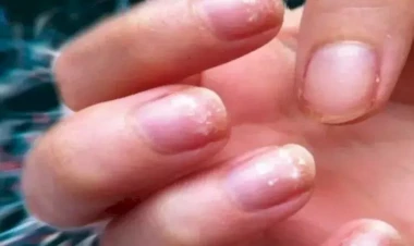 Dırnaqlardakı dəyişikliklər qorxunc xəstəliyin əlamətidir