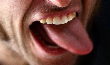 Daha çox kişi dilində rast gəlinən xəstəlik