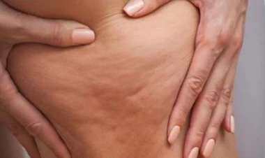 Selülitdən qurtulmağın təbii yolları