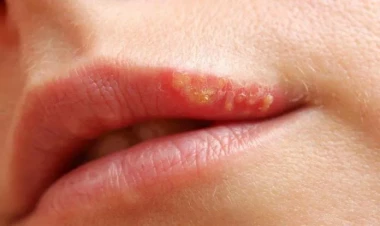 Dodağı uçuqlayanlar kor ola bilər - XƏBƏRDARLIQ