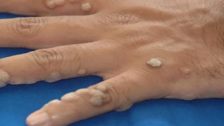 Ziyil və papilomalardan necə qurtulmalı? - RESEPTLƏR