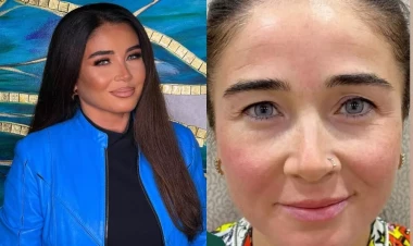 Elnarə estetik müdaxilələrdən əvvəl və sonra - FOTO