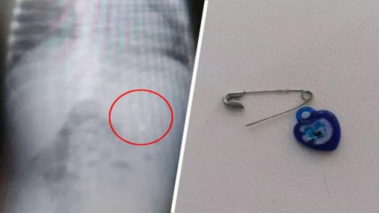 Körpə açıq sancaq və gözmuncuğu uddu - Daxili orqanları...