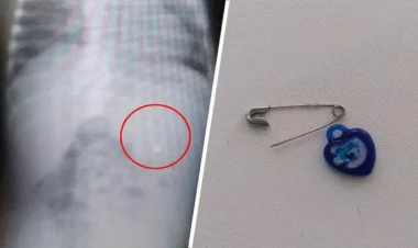 Körpə açıq sancaq və gözmuncuğu uddu - Daxili orqanları...