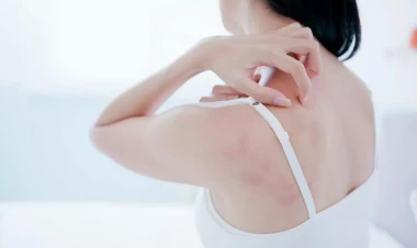 Bədəndəki hansı ləkələr təhlükəlidir? - Onkoloqdan AÇIQLAMA