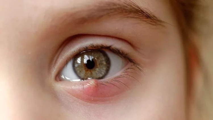 Gözdə “itdirsəyi” – Təhlükəlidir?