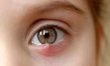 Gözdə “itdirsəyi” – Təhlükəlidir?