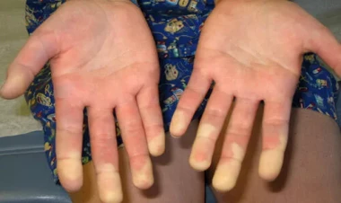 Əlləriniz tez-tez soyuq olursa, mütləq oxuyun!