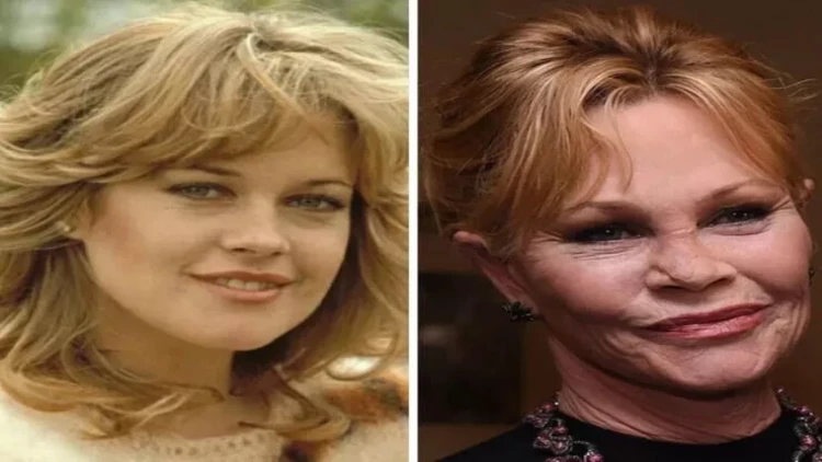 Plastik əməliyyatlardan doymayan məşhurlar - FOTO