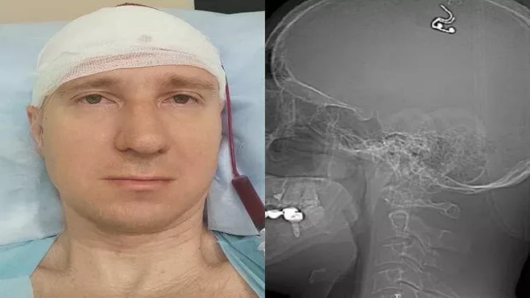 Drellə beynini deşərək elektrod yerləşdirdi - Əvvəl qoyunlarda yoxladı, sonra özündə... - FOTO