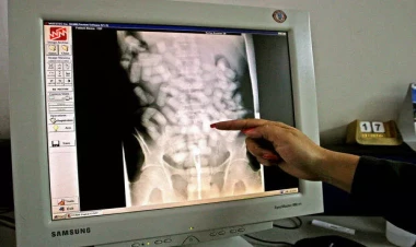 İranlı qadının mədəsindən 126 həşiş kapsulu çıxdı