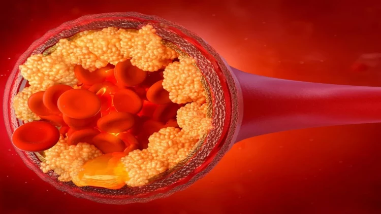 Ailənizdə infarkt olan varsa... - Araşdırmanın qorxunc nəticələri üzə çıxdı