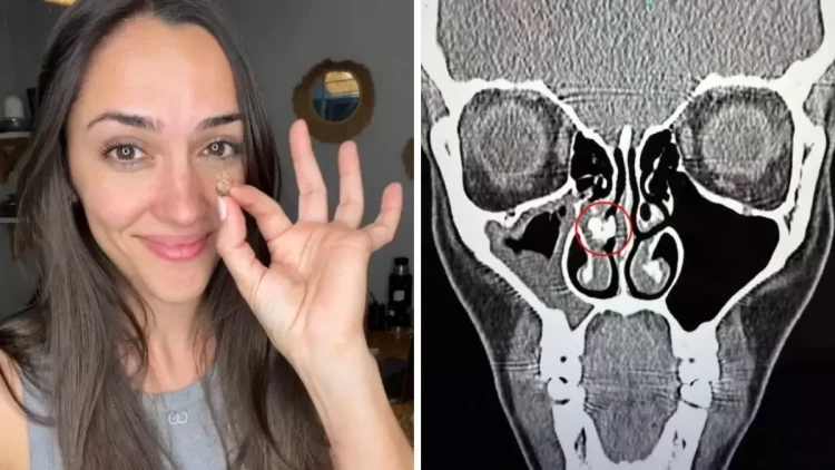 Qadının burnundan görün nə çıxdı - 35 ildir belə yaşayıbmış...