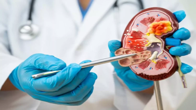 Böyrək daşlarının yaranmasına səbəb olan qidalar açıqlandı