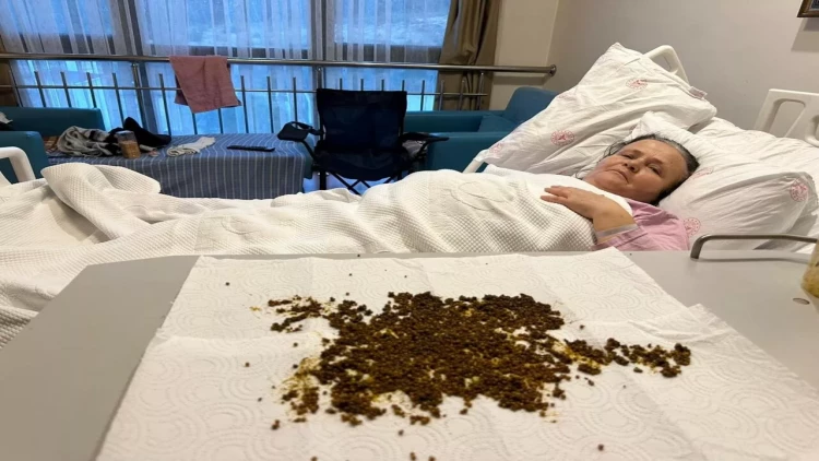 Qarın ağrısından şikayət etdi, ödündən 20 mindən çox daş çıxdı - FOTO