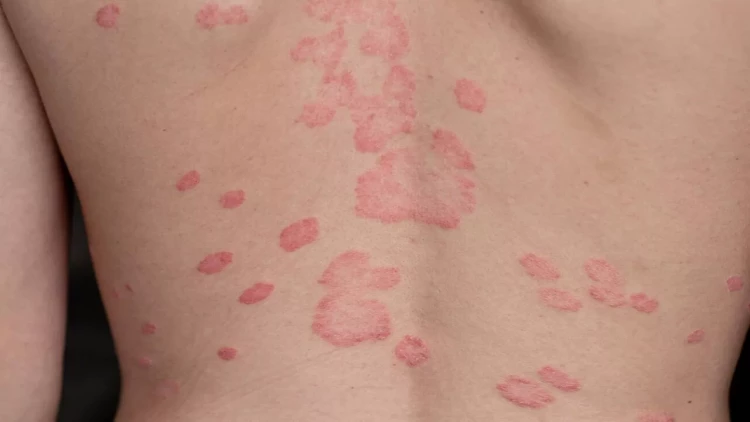 Beldəki səpkilərin yaranma səbəbi açıqlandı