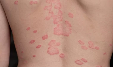 Beldəki səpkilərin yaranma səbəbi açıqlandı