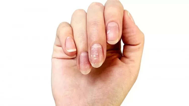 Çinko çatışmazlığı nələrə səbəb olur - problemi aradan qaldırmağın yolları