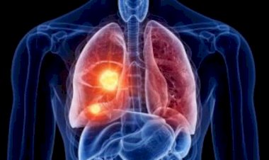 ​Avstraliyalı alimlərdən yeni kəşf: 1 saat ərzində xərçəngi məhv edir