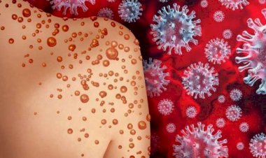 Azərbaycanda meymunçiçəyi ilə bağlı açıqlama