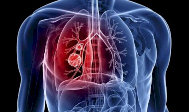 Kişilərin xərçəngdən ölümü bu tarixdə iki dəfə artacaq