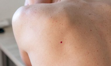 Dermatoloq dəridə qırmızı nöqtələrin yaranma səbəblərini açıqladı