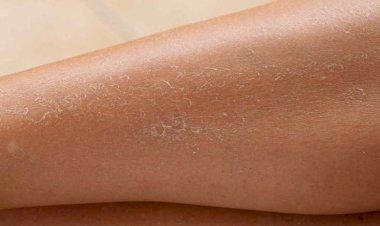 Azərbaycanda ixtioz xəstələrinin sayı açıqlandı